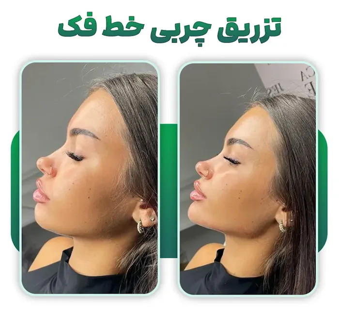 تزریق چربی خط فک