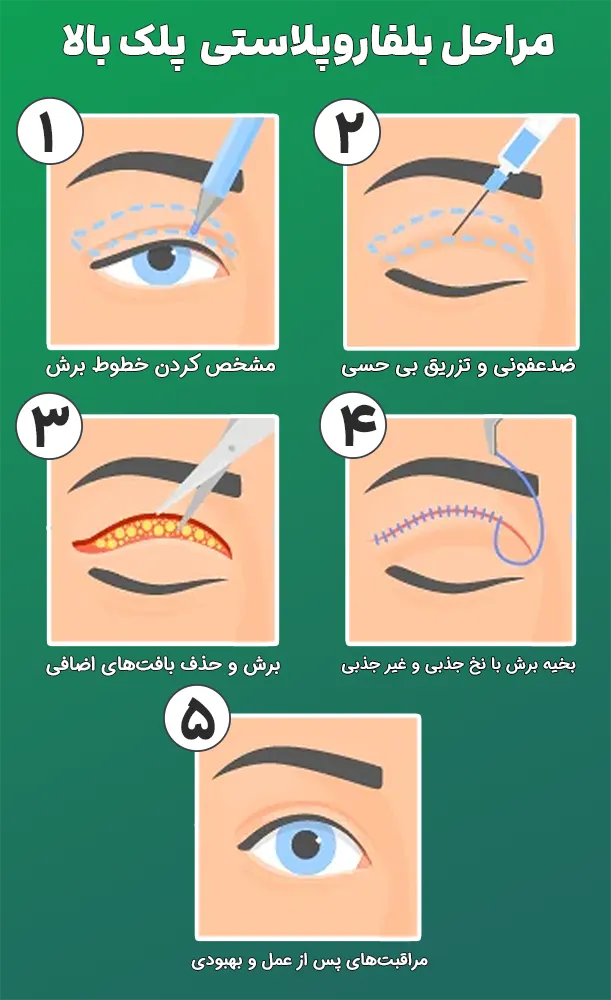 نحوه انجام بلفاروپلاستی پلک بالا