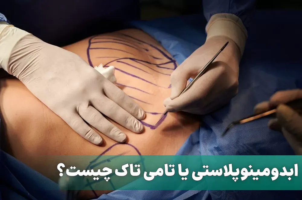 ابدومینوپلاستی تامی تاک