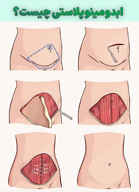 ابدومینوپلاستی چیست؟