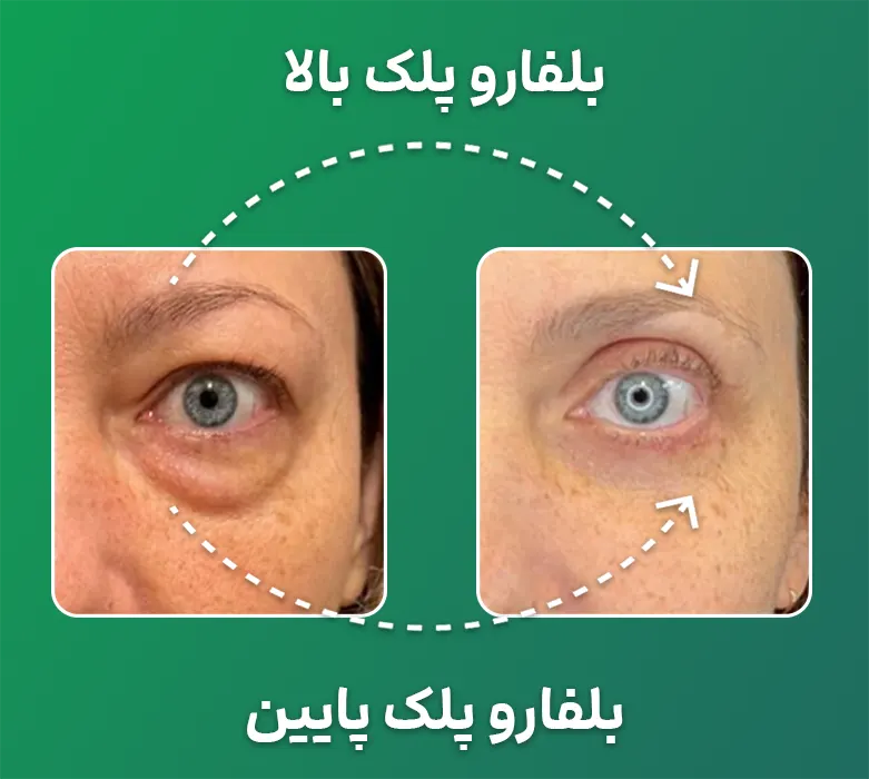 تفاوت بلفاروپلاستی پلک بالا و پایین؟