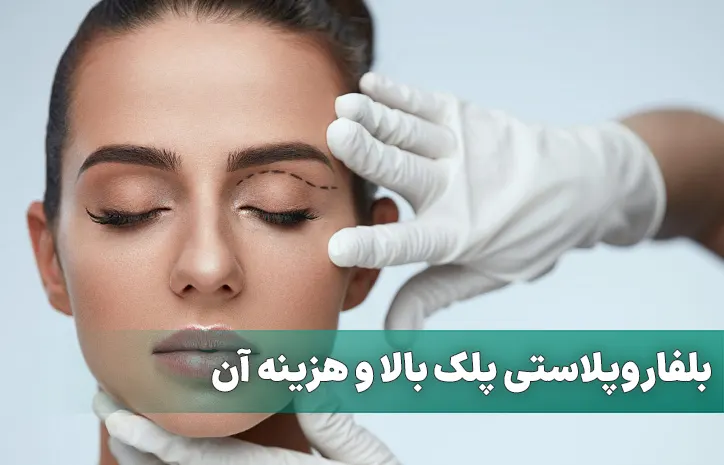 بلفاروپلاستی پلک بالا و هزینه آن