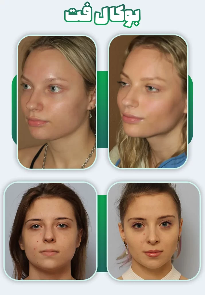 بوکال فت قبل بعد