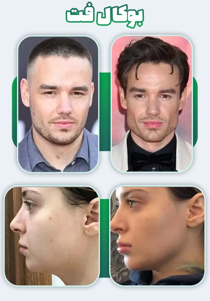 بوکال فت قبل بعد