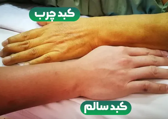 رنگ پوست کبد چرب