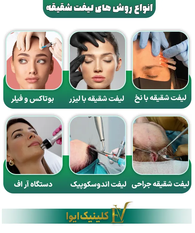 انواع لیفت شقیقه