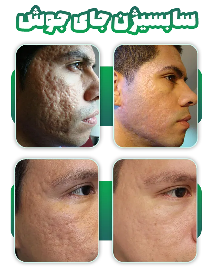 قبل و بعد سابسیژن جای جوش