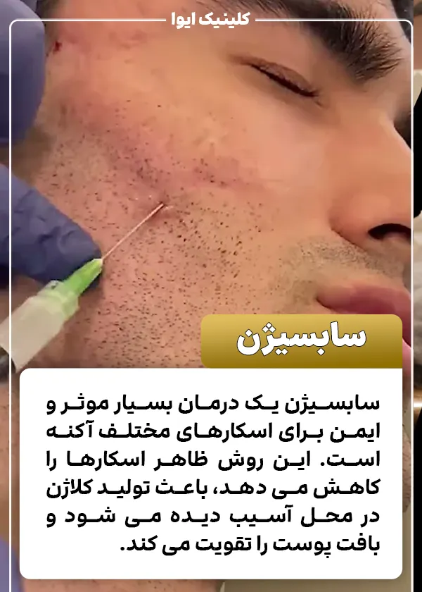 سابسیژن چیست