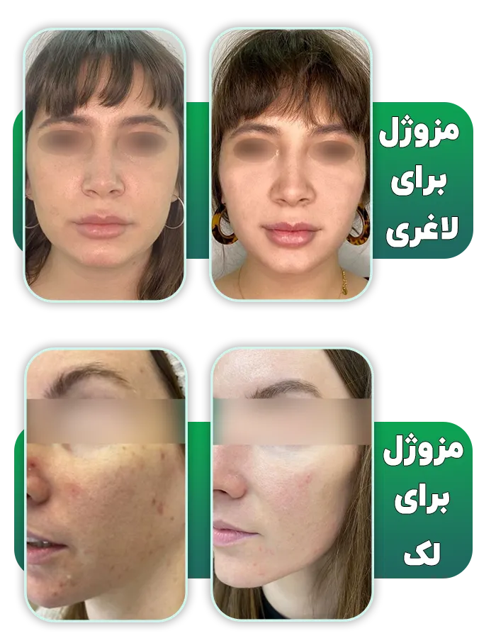 قبل بعد مزوژل