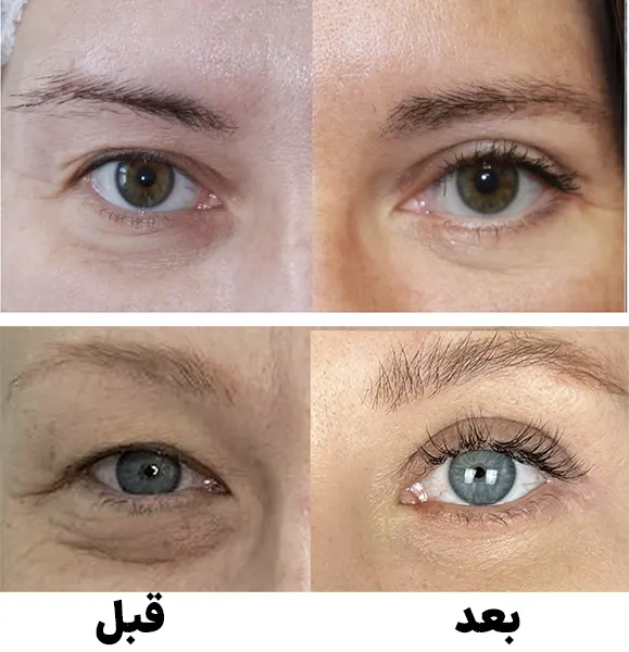 قبل و بعد بلفاروپلاستی