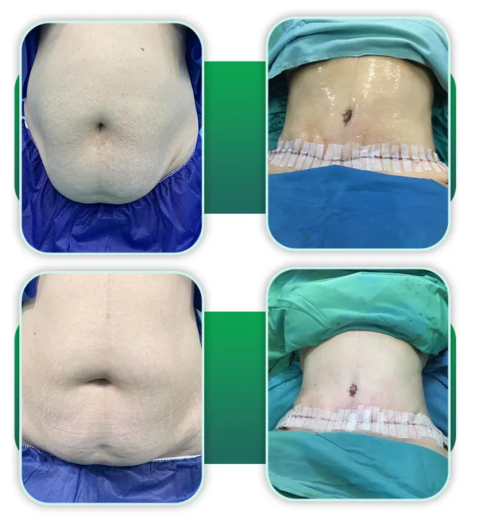قبل و بعد تامی تاک ابدومینوپلاستی