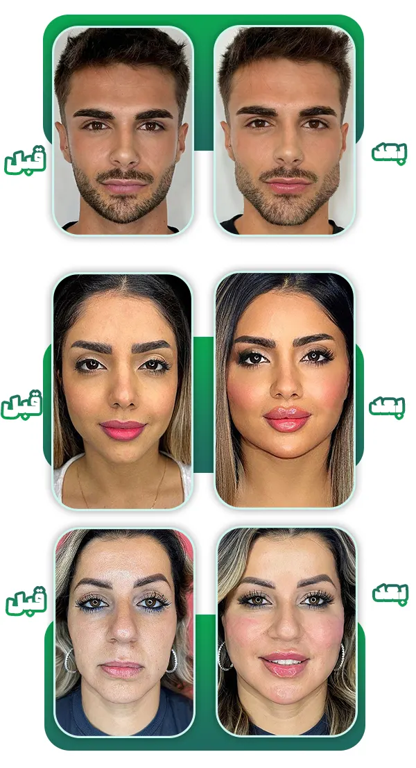 قبل و بعد تزریق چربی