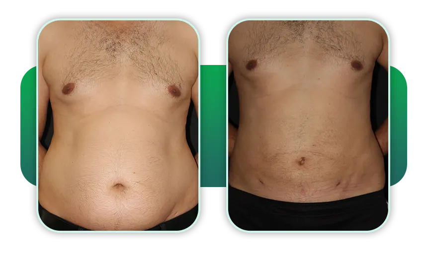 قبل و بعد لیپوماتیک