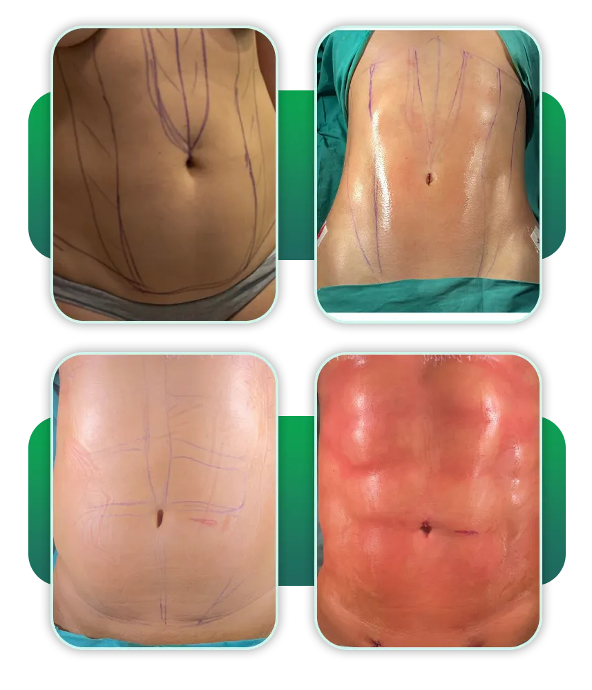 قبل و بعد لیپوماتیک