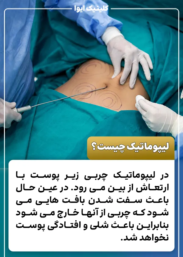 لیپوماتیک چیست؟