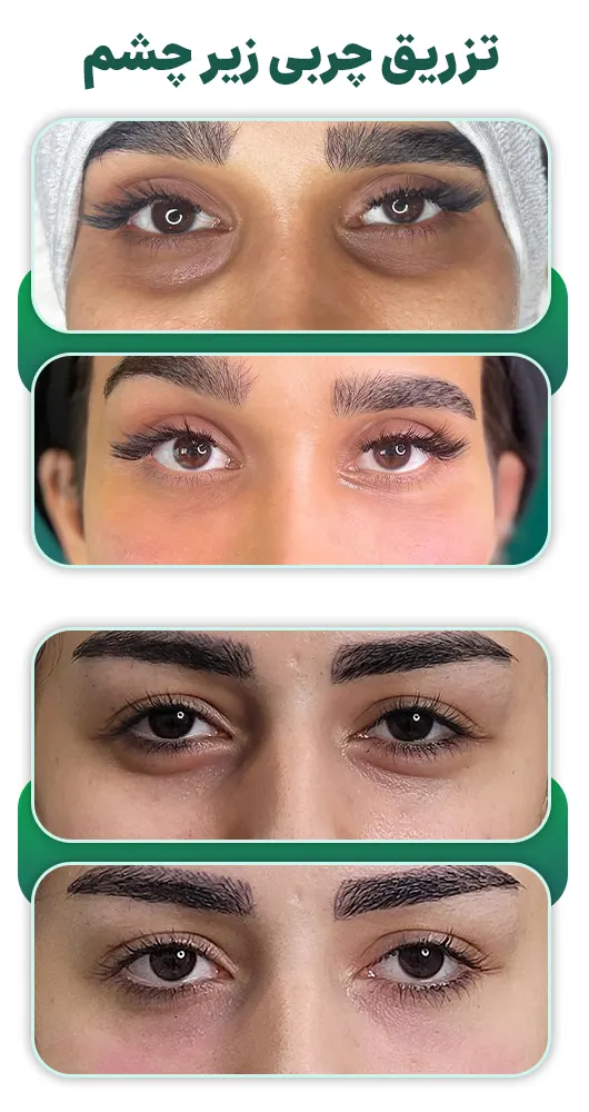 چربی زیر چشم