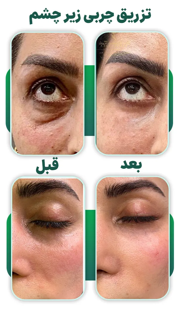 تزریق چربی زیر چشم