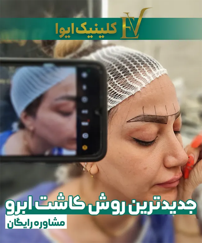 کاشت ابرو