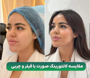 کانتورینگ صورت با فیلر و چربی
