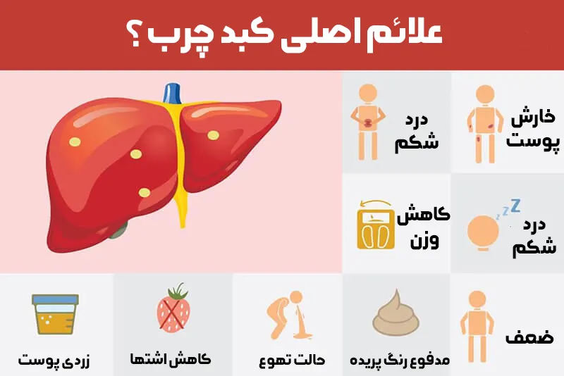 علائم اصلی کبد چرب