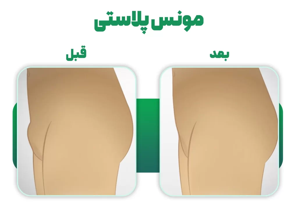 قبل و بعدمونس پلاستی