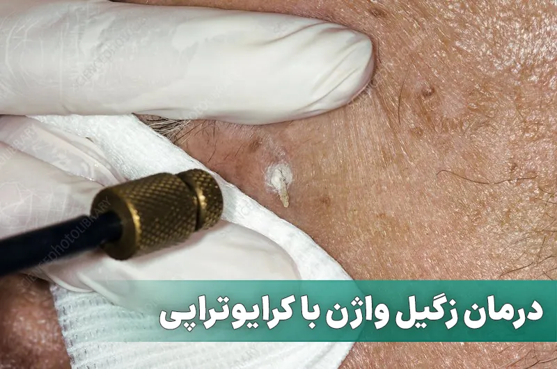 کرایوتراپی زگیل