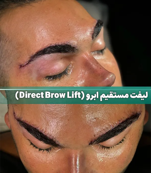 لیفت مستقیم ابرو
