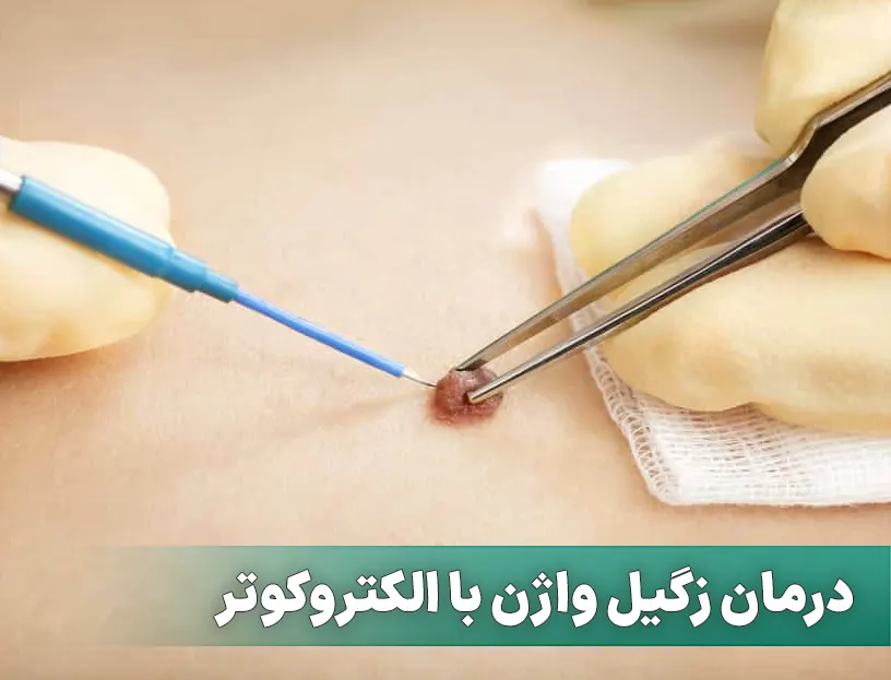 الکتروکوتر زگیل