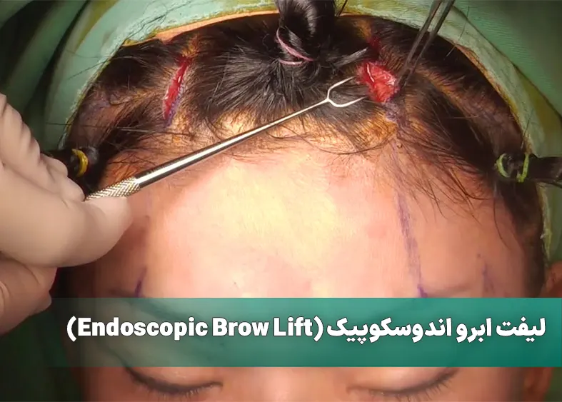 لیفت ابرو اندوسکوپیک