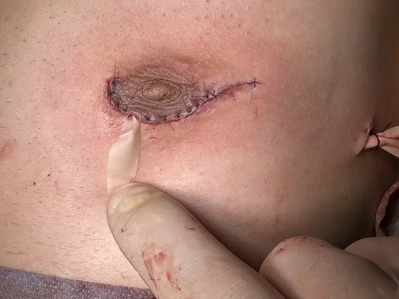 ژنیکوماستی