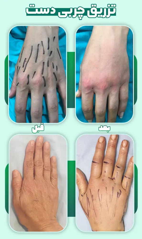 تزریق چربی دست