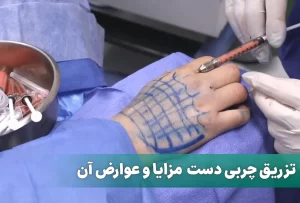 تزریق چربی دست
