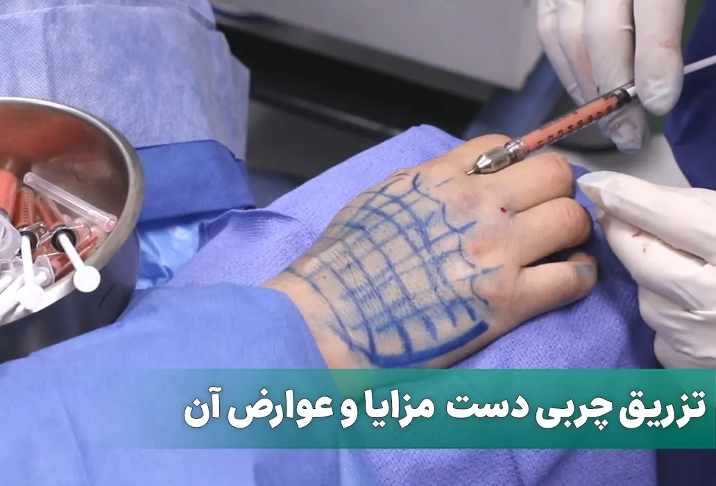 تزریق چربی دست