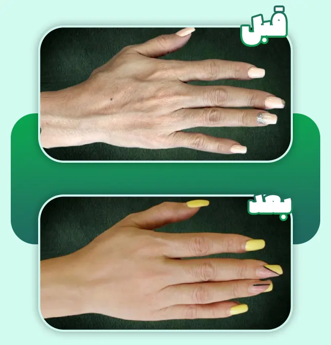 تزریق چربی دست