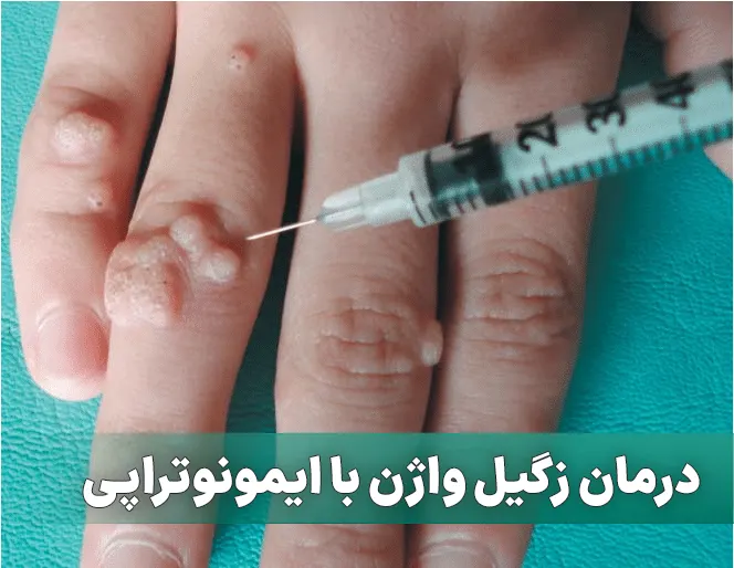ایمونوتراپی زگیل