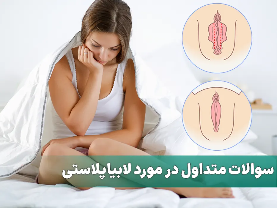 سوالات متداول در مورد لابیاپلاستی