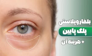 بلفاروپلاستی پلک پایین