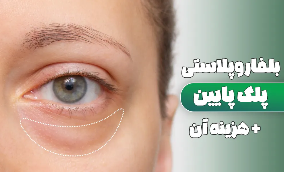 بلفاروپلاستی پلک پایین
