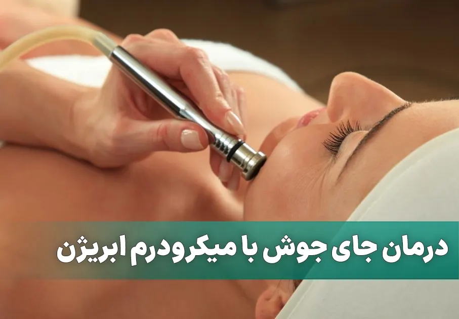 میکرودرم آبریژن