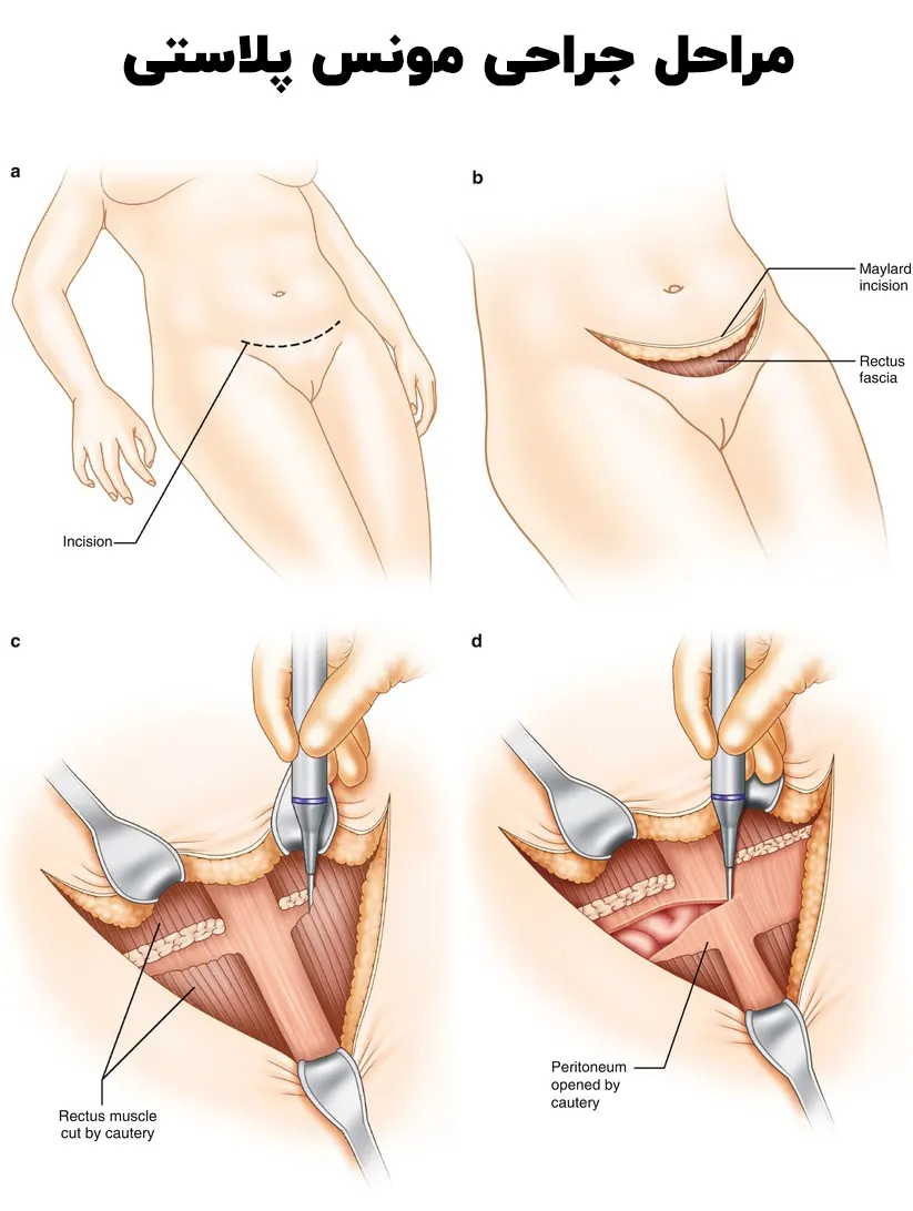 مراحل انجام مونس پلاستی