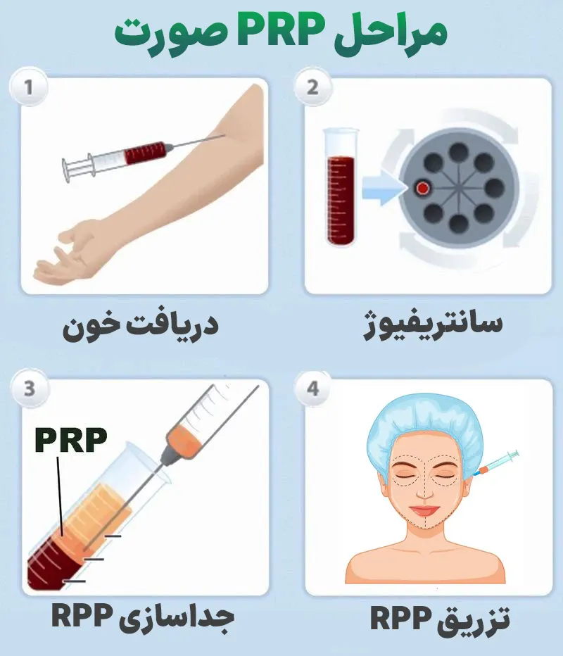 پی آر پی صورت چیست