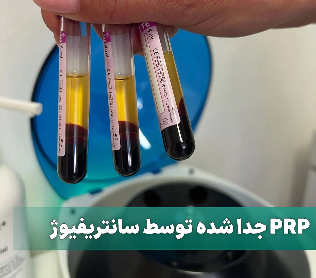 پی آر پی چیست