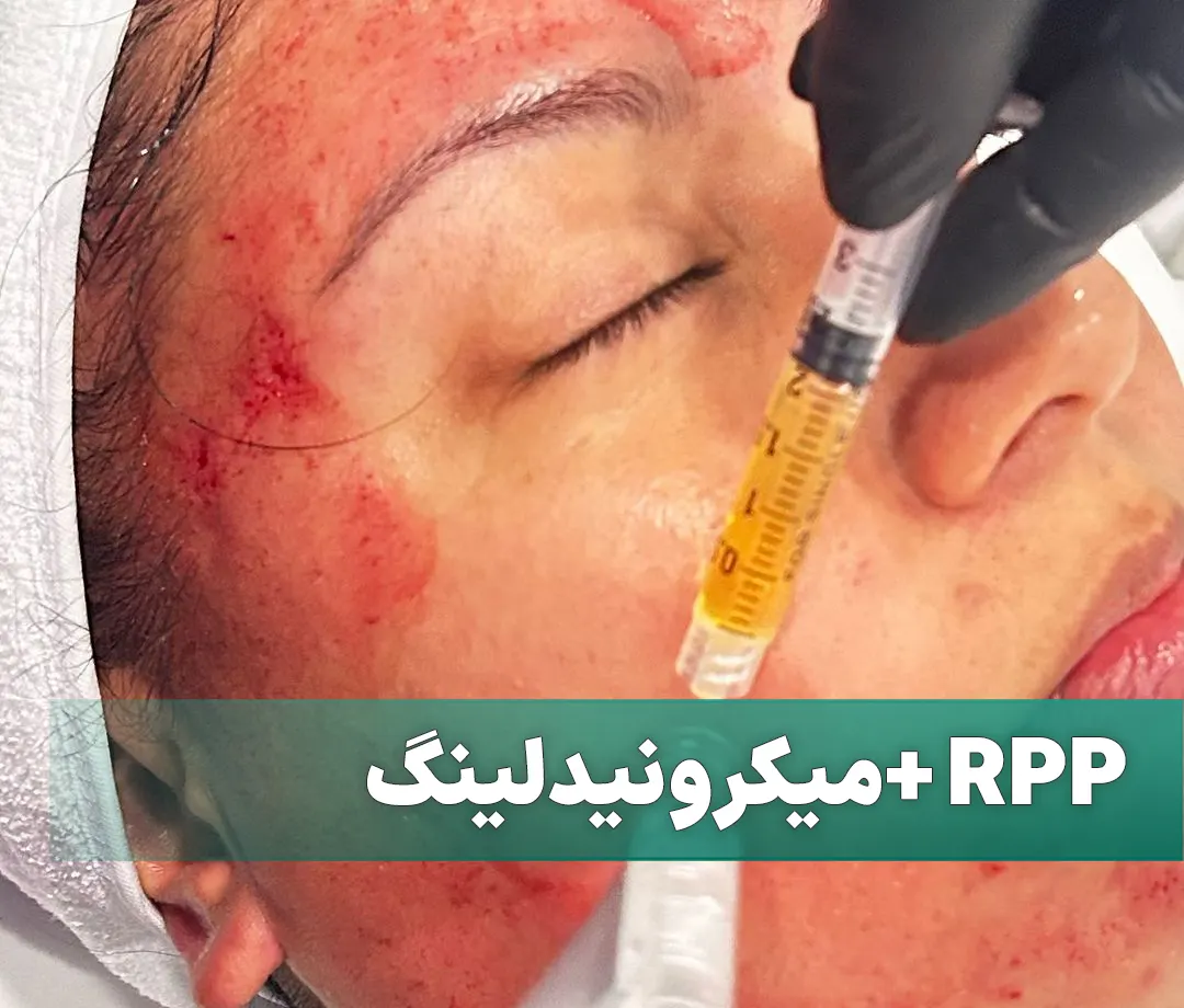 پی آر پی صورت با میکرونیدلینگ