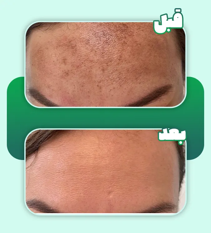 پی آر پی صورت