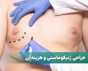 جراحی ژنیکوماستی