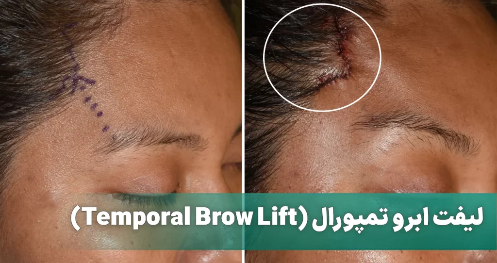 لیفت ابرو تمپورال