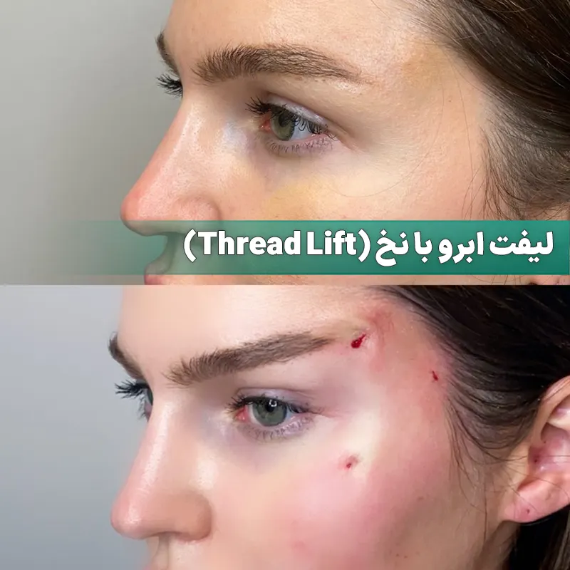لیفت ابرو با نخ