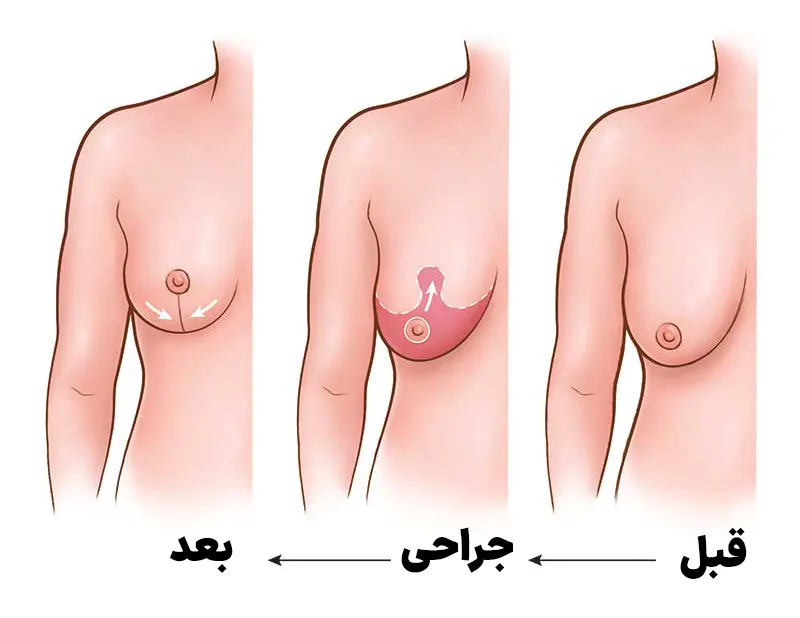 جراحی لیفت سینه