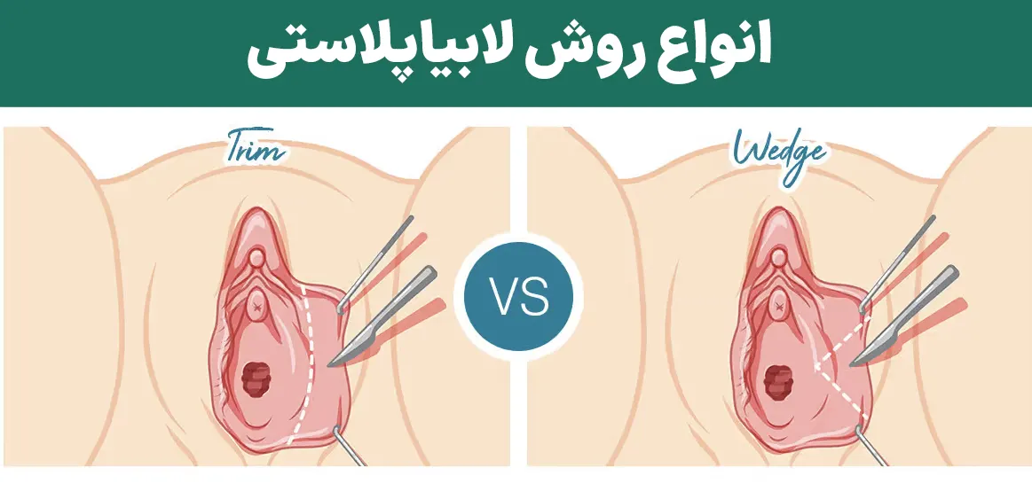 انواع روش لابیاپلاستی