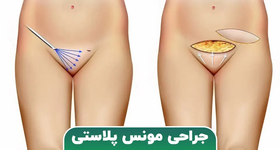 مونس پلاستی